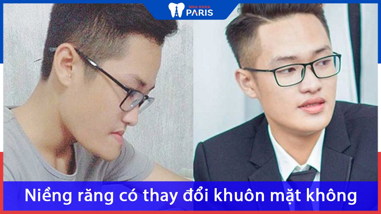 Niềng răng có thay đổi khuôn mặt không? Thay đổi như thế nào?
