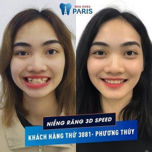 Hình ảnh trước và sau khi niềng răng: Sự khác biệt rõ rệt