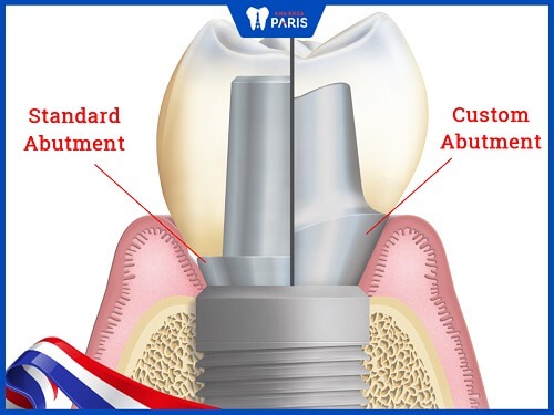 sự khác nhau giữa 2 loại abutment implant