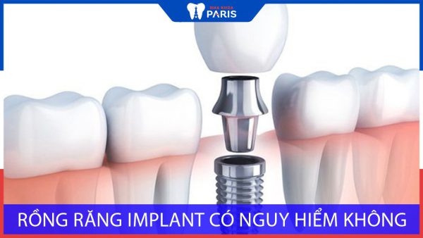 Trồng răng Implant có nguy hiểm không? Có ảnh hưởng gì không?