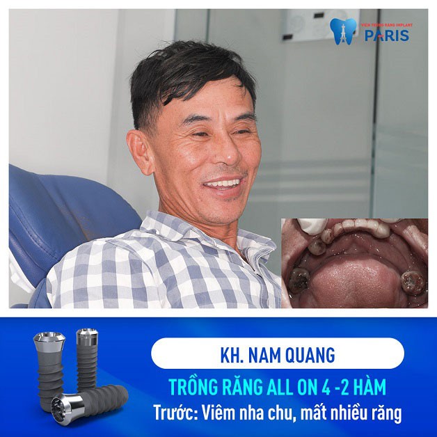 Chú Nam Quang trồng răng cả hàm