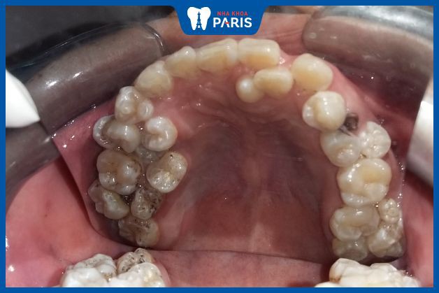 Răng mọc thừa có thể do nhiều hội chứng khác nhau