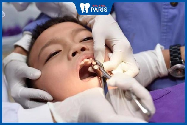Chi phí nhổ răng mọc thừa phụ thuộc vào độ khó và số lượng răng