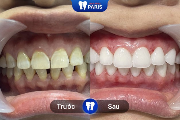 So sánh răng trước và sau khi bọc sứ