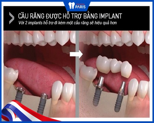 cầu răng sứ có implant hỗ trợ