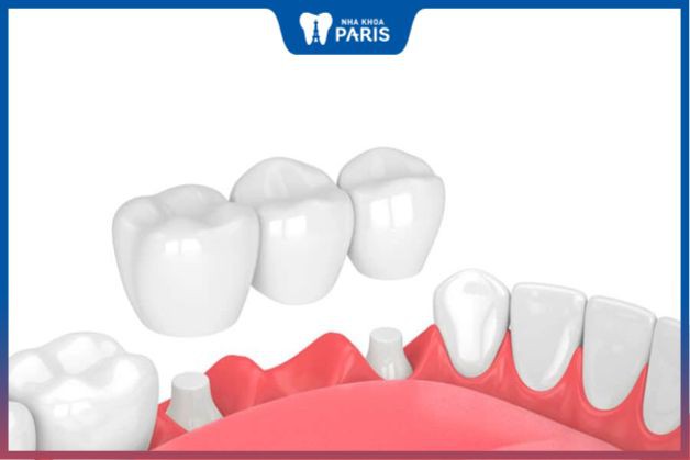 Cầu răng sứ là bọc răng sứ 2 đầu để chống đỡ cho răng giả ở giữa