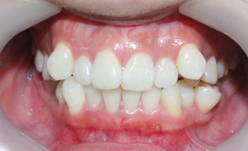 Răng lệch lạc nên niềng hay bọc sứ tốt hơn? Mức giá mỗi giải pháp