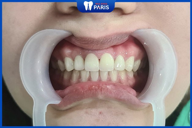 Răng sứ đảm bảo chức năng của mọi loại răng