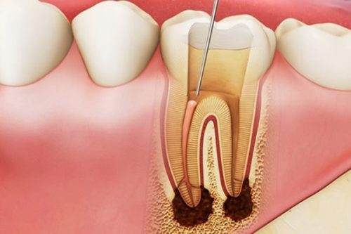 5 Cách làm chết tủy răng tại nhà đơn giản và nguy hiểm khôn lường