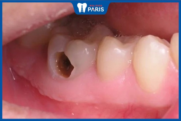 Răng sâu bị thủng lỗ do vi khuẩn tấn công
