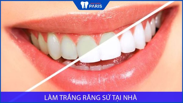 Cách làm trắng răng sứ tại nhà sạch như mới – tại nha khoa paris