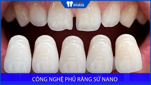 Phủ răng sứ Nano là gì? Giá bao nhiêu tiền? Có tốt không?