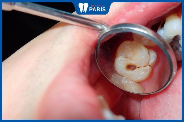 Răng bị thủng lỗ nhỏ gây ra nhiều biến chứng