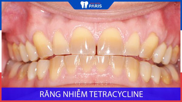 Răng nhiễm Tetracycline: Nguyên nhân & Cách điều trị dứt điểm