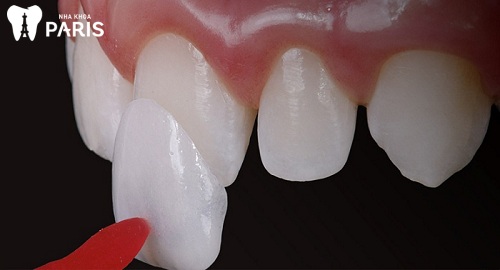 Răng phủ sứ nano giá bao nhiêu