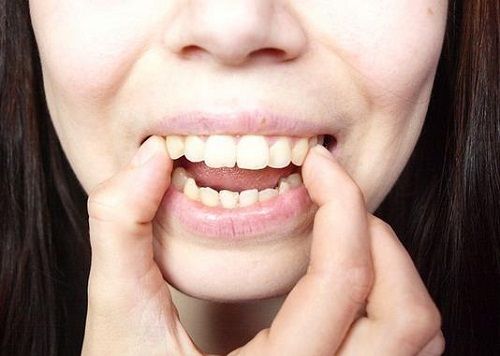 tại sao răng càng ngày càng hô