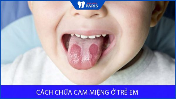 Cách chữa cam miệng ở trẻ em hiệu quả. Phòng tránh và Kiêng ăn gì