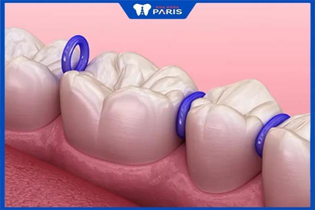 Dây thun tách kẽ có tác dụng nới khoảng cách giữa các răng