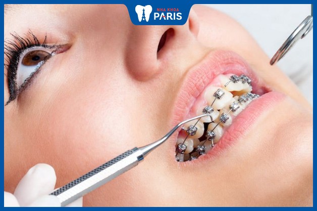 Mắc cài niềng răng bị tuột có ảnh hưởng gì không?