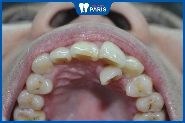 Tình trạng răng mọc lẫy khi răng sữa chưa rụng