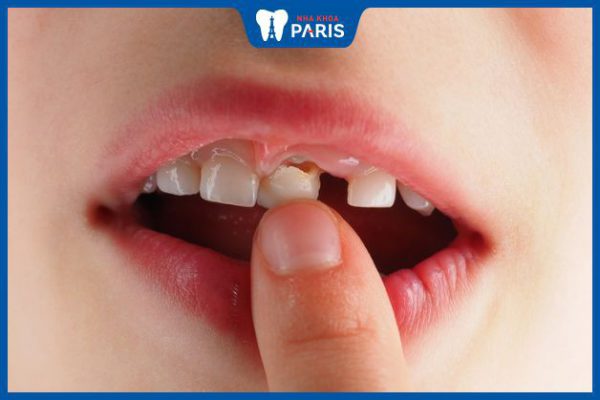 Răng sữa mới lung lay có nên nhổ không? Nhổ răng đúng cách thế nào