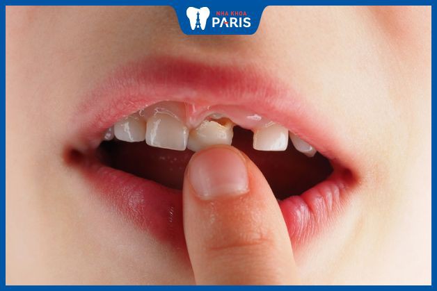 Tình trạng trẻ có răng sữa lung lay thì có nên nhổ bỏ không