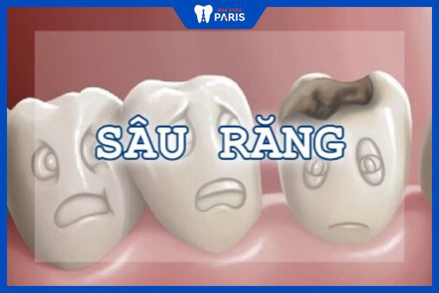 Sâu răng gây ra những cơn đau nhức, khó chịu