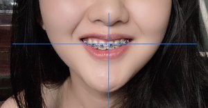Những nguyên nhân gây ra việc niềng răng không thành công