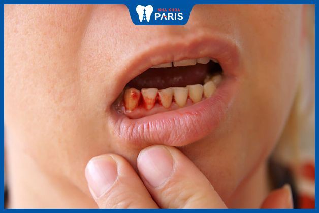 Thiếu canxi làm răng yếu, nhạy cảm, dễ đau