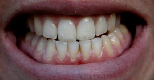 Răng thiếu canxi