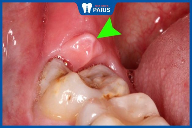 Vì sao răng bị lợi trùm hay xảy ra viêm nhiễm