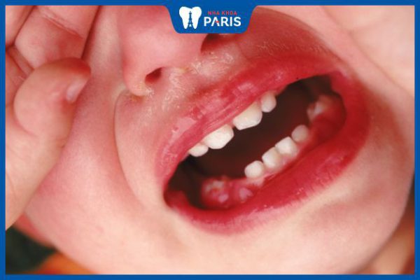 Trẻ sốt mọc răng hàm: Nguyên nhân, dấu hiệu và cách xử lý