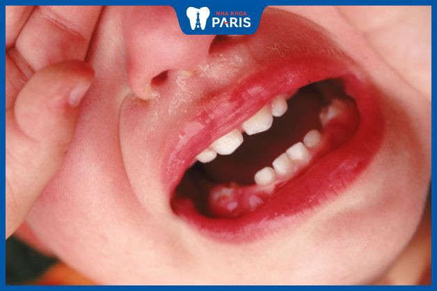 Trẻ mọc răng hàm thường quấy khóc, lười ăn