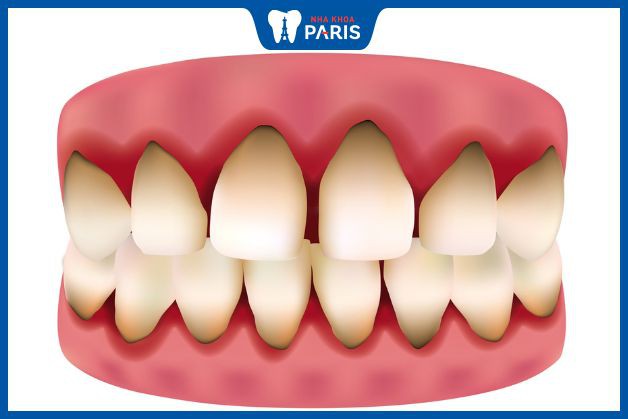 Bị đen chân răng là dấu hiệu mắc các bệnh lý răng miệng