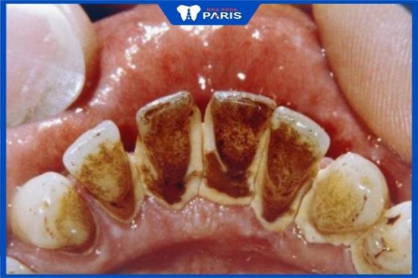 Răng bị đen ở mặt trong, ở kẽ: Nguyên nhân & Cách Khắc Phục