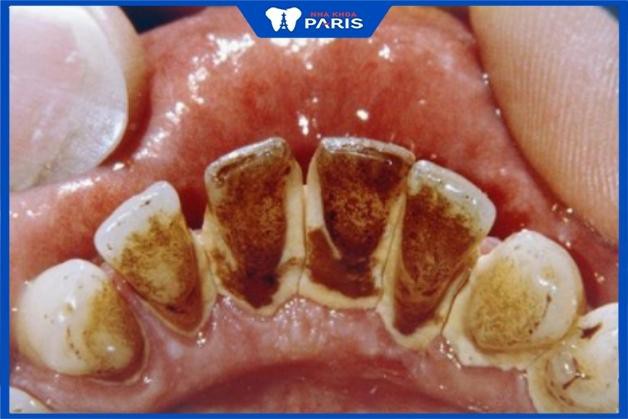 Răng bị đen ở mặt trong, ở kẽ: Nguyên nhân & Cách Khắc Phục
