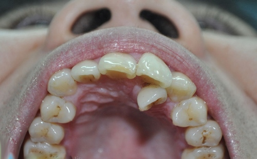 răng mọc thừa phía trong