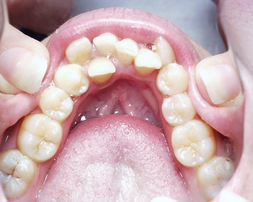 răng mọc thừa phía trong