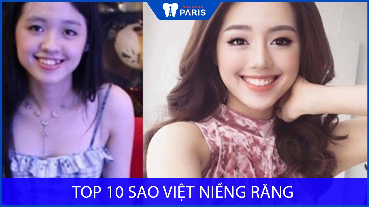 Top 10 SAO VIỆT niềng răng thành công nhất