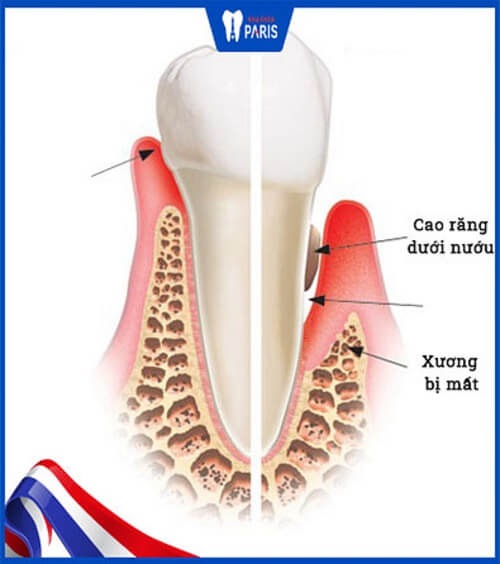 cao răng dưới nướu