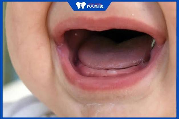 Trẻ mọc 1 răng cửa hàm dưới