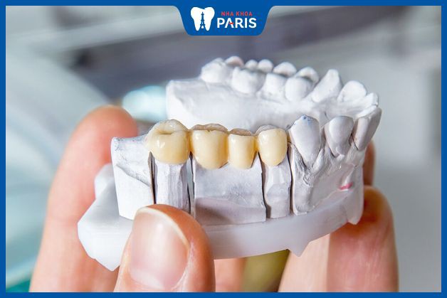 Cầu răng sứ có nhiều mức giá khác nhau