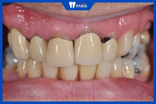 Bọc răng sứ kim loại dễ bị đen cả hàm