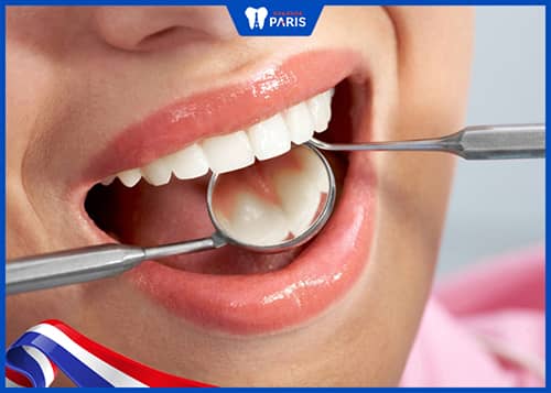 Vật liệu hàn răng có tính thẩm mỹ cao