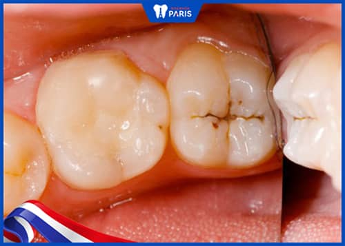 Nên chọn loại vật liệu trám răng nào với trường hợp sâu răng bình thường