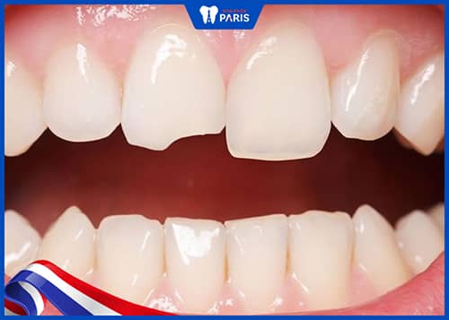 Nên chọn loại vật liệu trám răng nào với trường hợp sứt, mẻ răng