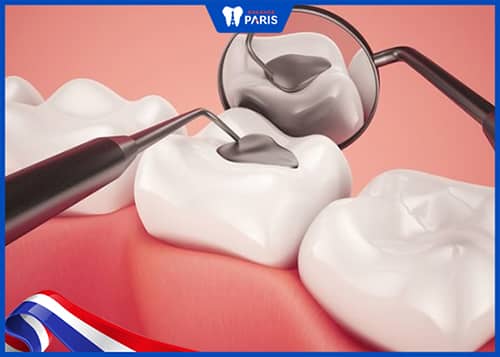 Vật liệu hàn răng có độ bền tốt