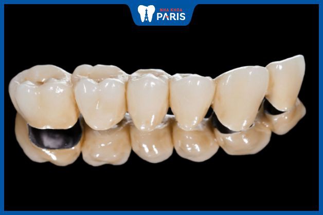 Răng sứ kim loại được bảo hành khoảng 1 - 2 năm