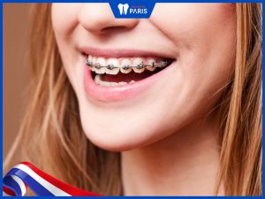 Niềng răng Vline – Kỹ thuật làm đẹp tự nhiên không cần phẫu thuật