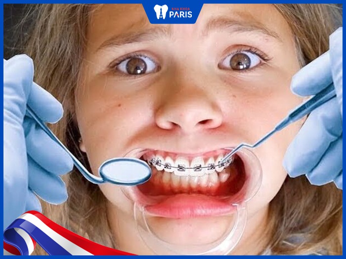 Tại sao Niềng răng xong bị hở lợi? Khắc phục như thế nào?